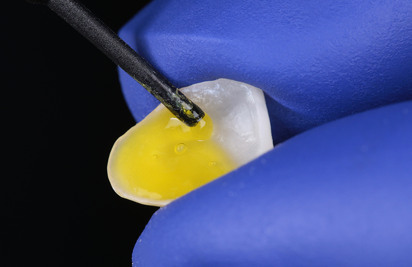 Vorbehandlung eines Glaskeramik-Veneers mit Flusssäure. Bilder mit freundlicher Genehmigung von Dr. Paulo Monteiro.